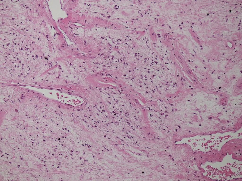 Abdominal Wall Tumor Photo By Surgicalpathology Photobucket 5997