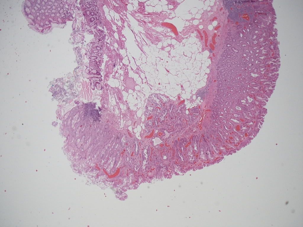 Hepatic Flexure Polyp