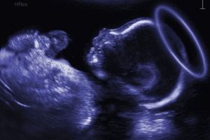 Ultrasound photo of a baby with a halo