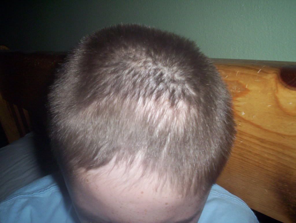 trichotillomania in toddlers